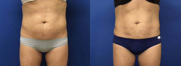 Body Lift - Colts Neck, New Jersey - Dr. Rudolf Thompson